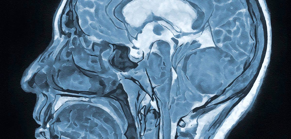 „Dank der Hypnose können wir in der Regel einen größeren Teil des Tumors entfernen“